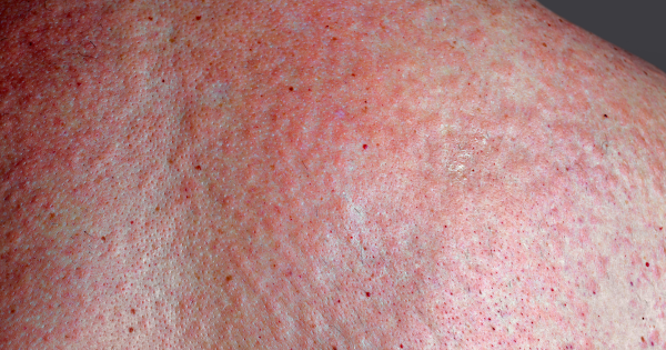 麻疹殺入香港機場！268人列密切接觸 病毒在空中可活2小時 可引發致命腦炎