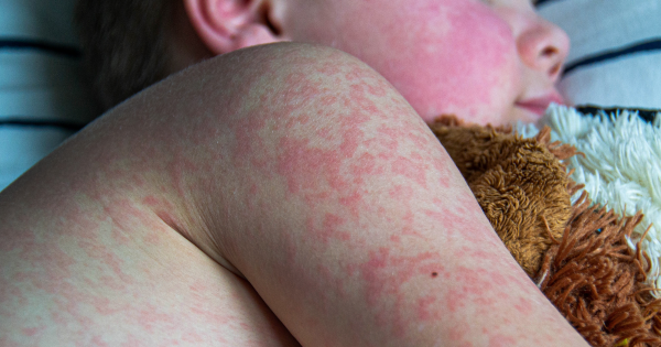 麻疹殺入香港機場！268人列密切接觸 病毒在空中可活2小時 可引發致命腦炎