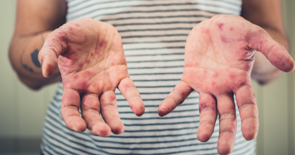 麻疹殺入香港機場！268人列密切接觸 病毒在空中可活2小時 可引發致命腦炎