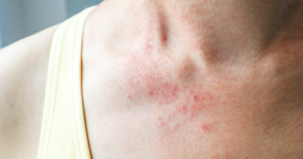 麻疹殺入香港機場！268人列密切接觸 病毒在空中可活2小時 可引發致命腦炎