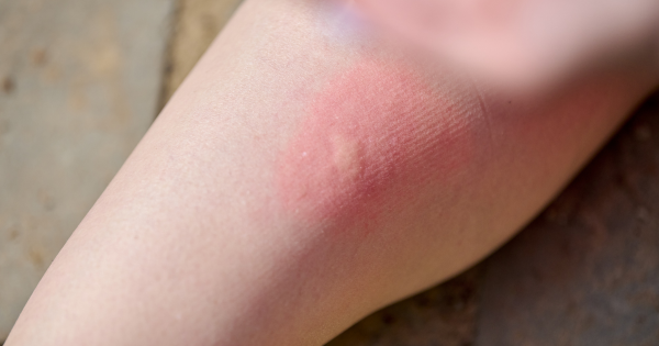 今年暴雨季提前！厄爾尼諾恐引爆史詩級蚊患 專家警告：呢幾個月高危