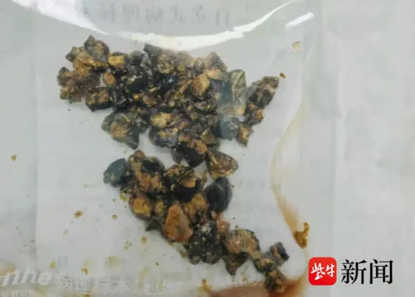 專家揭不吃早餐5大癌症風險增近6倍！醫生：或致缺血性腦中風／女子因此生60粒膽石...