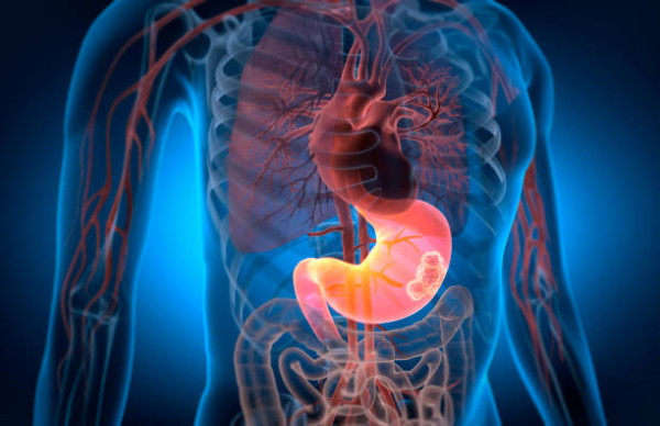 專家揭不吃早餐5大癌症風險增近6倍！醫生：或致缺血性腦中風／女子因此生60粒膽石...