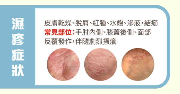 亂搽藥膏恐惡化！1招分辨熱痱/濕疹/過敏 專家揭3大致敏原附舒緩法