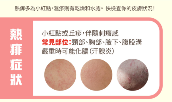 亂搽藥膏恐惡化！1招分辨熱痱/濕疹/過敏 專家揭3大致敏原附舒緩法