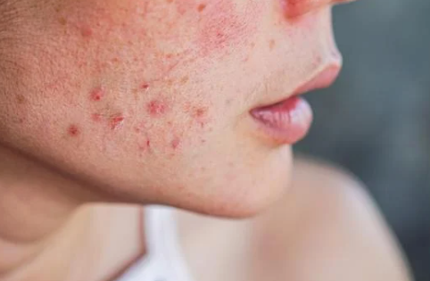 亂搽藥膏恐惡化！1招分辨熱痱/濕疹/過敏 專家揭3大致敏原附舒緩法