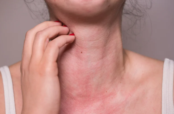 亂搽藥膏恐惡化！1招分辨熱痱/濕疹/過敏 專家揭3大致敏原附舒緩法