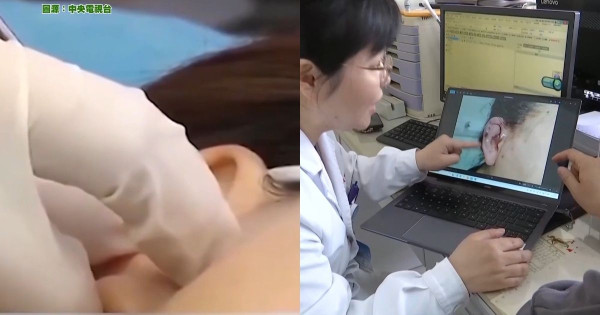內地興起「精靈耳」整容手術熱潮 央視揭恐怖後果！最嚴重可致終身殘疾 
