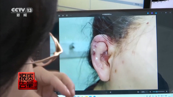 內地興起「精靈耳」整容手術熱潮 央視揭恐怖後果！最嚴重可致終身殘疾 