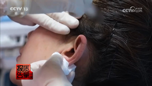 內地興起「精靈耳」整容手術熱潮 央視揭恐怖後果！最嚴重可致終身殘疾 