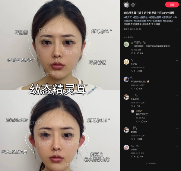 內地興起「精靈耳」整容手術熱潮 央視揭恐怖後果！最嚴重可致終身殘疾 