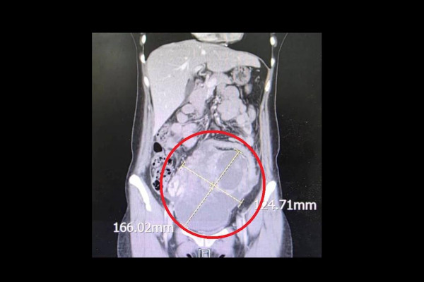 44歲女肚脹無胃口揭患罕見雙癌！醫生拆解4大隱形婦科警號  附檢查貼士