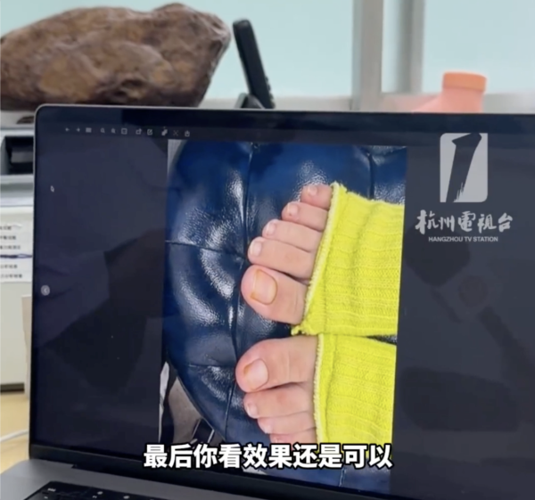 著襪瞓覺出事！腳趾慘變恐怖千層酥 醫生警告非灰甲只能拔除