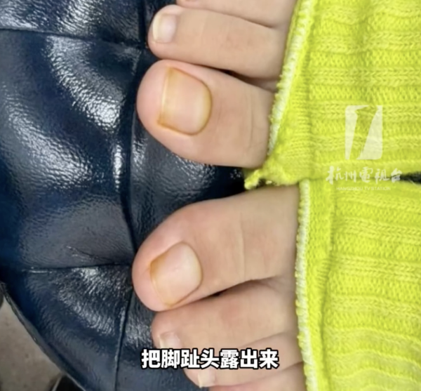 著襪瞓覺出事！腳趾慘變恐怖千層酥 醫生警告非灰甲只能拔除