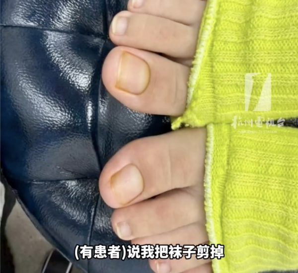 著襪瞓覺出事！腳趾慘變恐怖千層酥 醫生警告非灰甲只能拔除