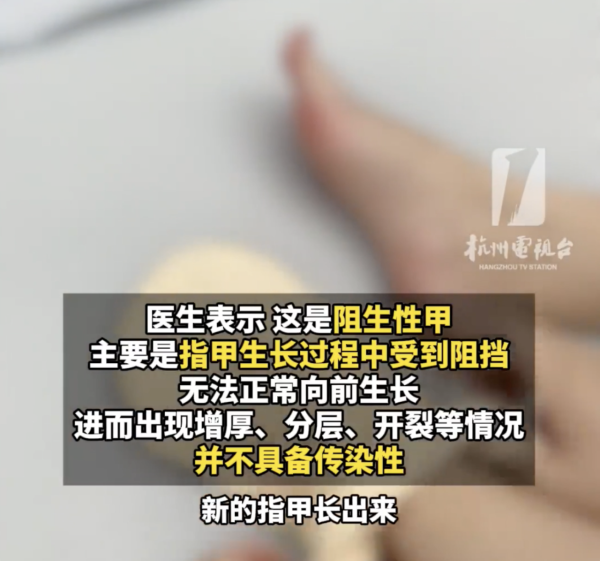 著襪瞓覺出事！腳趾慘變恐怖千層酥 醫生警告非灰甲只能拔除