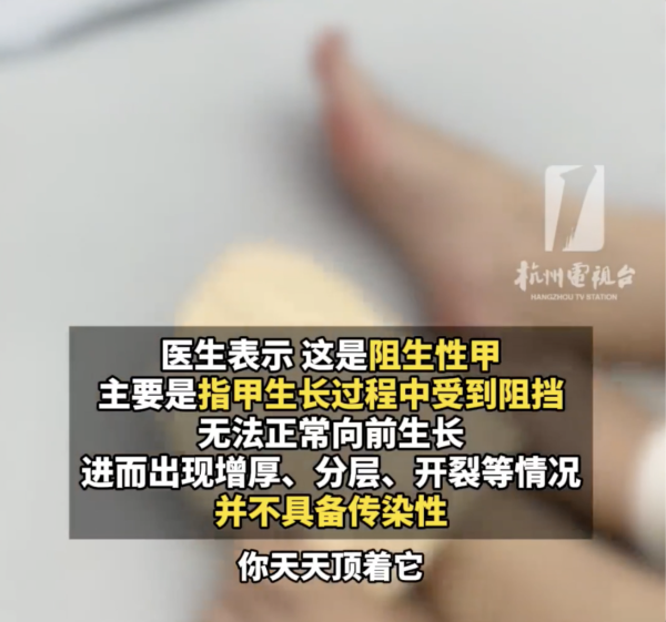 著襪瞓覺出事！腳趾慘變恐怖千層酥 醫生警告非灰甲只能拔除