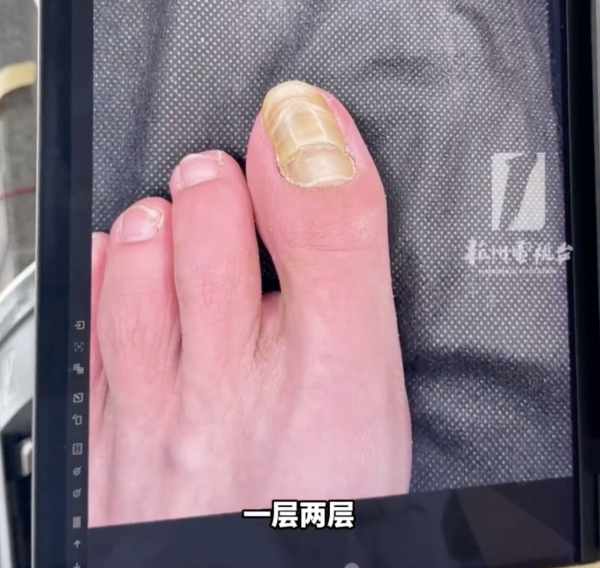 著襪瞓覺出事！腳趾慘變恐怖千層酥 醫生警告非灰甲只能拔除