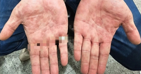 露營惹性病？男手掌生紅斑以為蟲咬 醫揭竟染二期梅毒附3大特徵