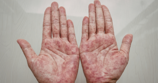 露營惹性病？男手掌生紅斑以為蟲咬 醫揭竟染二期梅毒附3大特徵