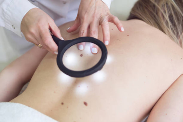 以為熱氣生暗瘡？57歲男嘴邊長痘拖幾年 驚變潰爛大腫瘤患皮膚癌
