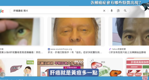 癌症原來真係有樣睇！醫生搭𨋢察覺同事面色異常暗沉 勸做腸鏡驚揭患大腸癌 3大典型癌症面相公開
