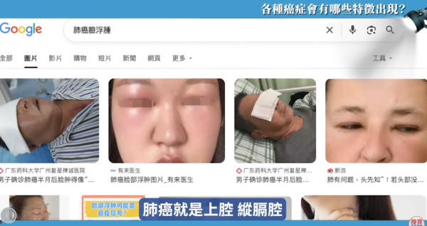 癌症原來真係有樣睇！醫生搭𨋢察覺同事面色異常暗沉 勸做腸鏡驚揭患大腸癌 3大典型癌症面相公開