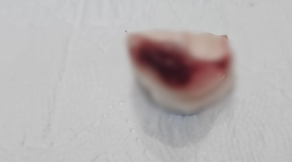 港人北上剝智慧齒險窒息！面腫含膿嚴重壓迫氣管 漏夜回港衝急症室保命