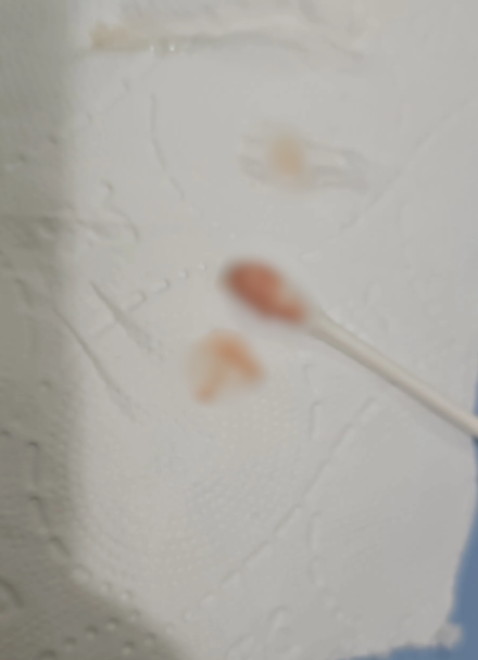 港人北上剝智慧齒險窒息！面腫含膿嚴重壓迫氣管 漏夜回港衝急症室保命