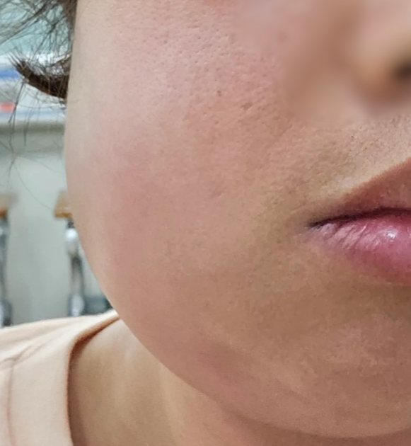 港人北上剝智慧齒險窒息!面腫含膿嚴重壓迫氣管 漏夜回港衝急症室保命
