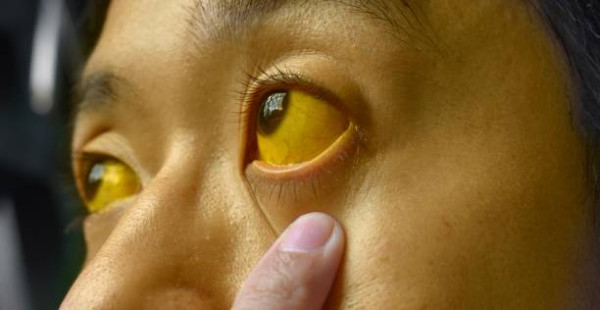 食飽肚痛以為胃痛？醫生揭飯後4症狀恐是胰臟炎/胰臟癌 附痛楚分辨法