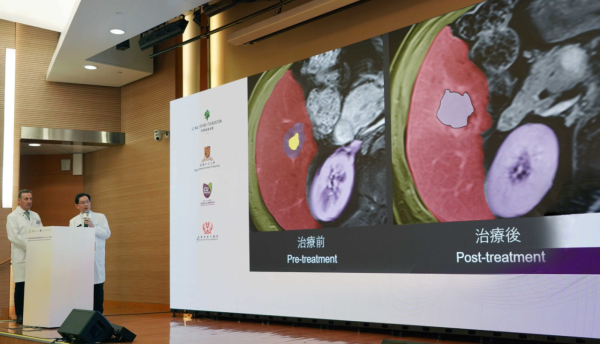 李嘉誠資助200肝癌病人到3私家醫院用Histotripsy免開刀碎癌 親閱求助信不忍保險不包斷送生機