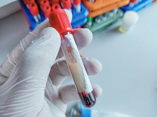 以為後生無事？26歲女血脂超標45倍患胰臟炎！醫生揭3大致命惡習
