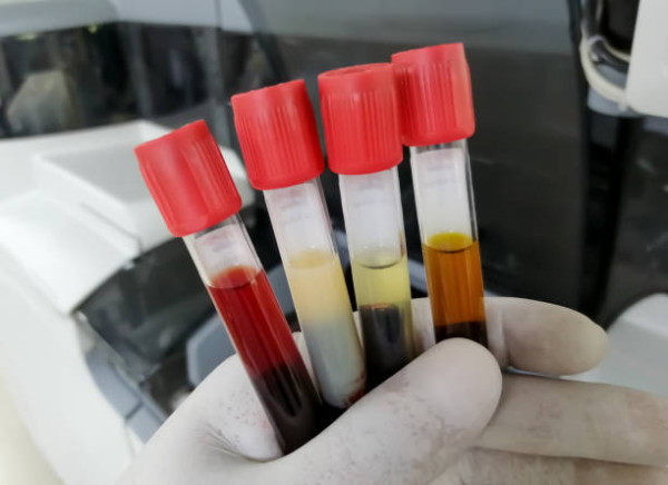 以為後生無事？26歲女血脂超標45倍患胰臟炎！醫生揭3大致命惡習