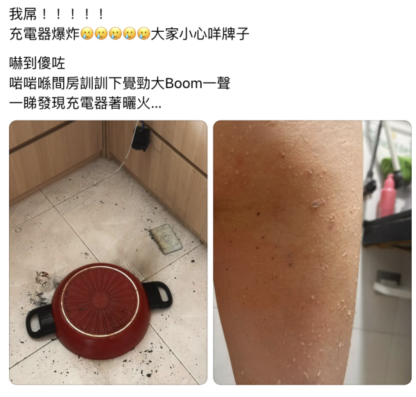 全港緊急自查！1型號尿袋數日內連環起火 信用卡證件全燒爛、女子腿部被炸傷
