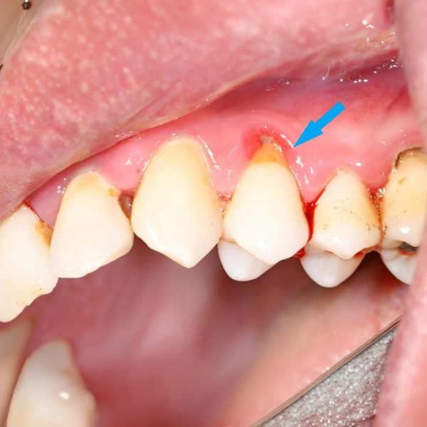 權威機構推介漱口水：NONIO溫和唔乸、有效抑菌！ 同場加推 +GUM TOTAL｢對抗牙肉萎縮｣功效¹