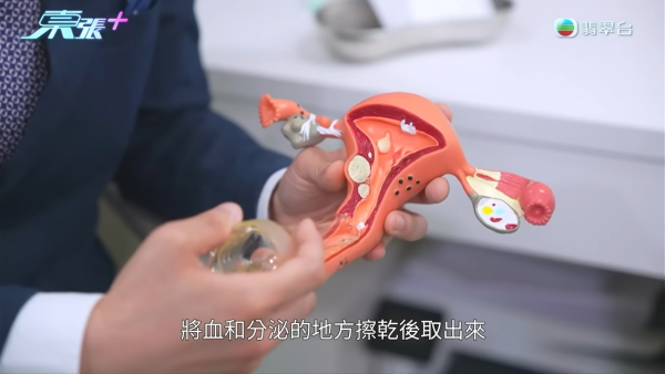 港女下體分泌物呈鏽色飄腐臭!陰道炎夾出黑血紗布球 驚揭公院婦科檢查恐怖真相