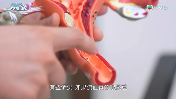 港女下體分泌物呈鏽色飄腐臭!陰道炎夾出黑血紗布球 驚揭公院婦科檢查恐怖真相