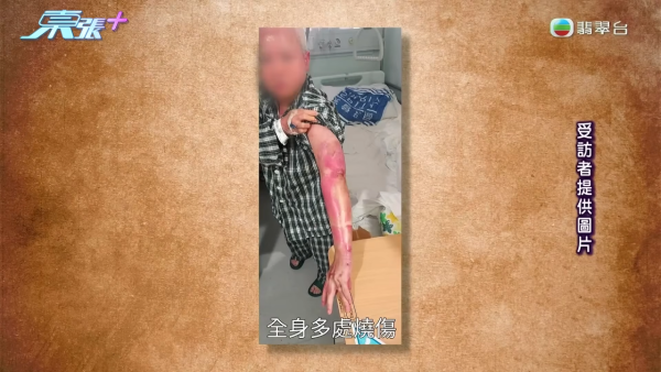 藍田邨廚房恐怖煤氣爆炸!女戶主四成皮膚燒傷「刮皮」淌血!命懸一線恐失工作能力