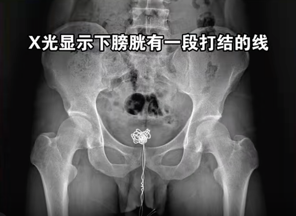 千萬咪模仿！28歲男貪刺激將1物塞尿道 死撐12小時出血始求醫 【手術畫面曝光】