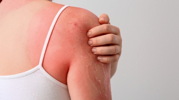 防晒攻略|擦SPF 100防晒不用再补?SPF 30够不够防护?专家揭秘防晒正确用法+黄金使用时间