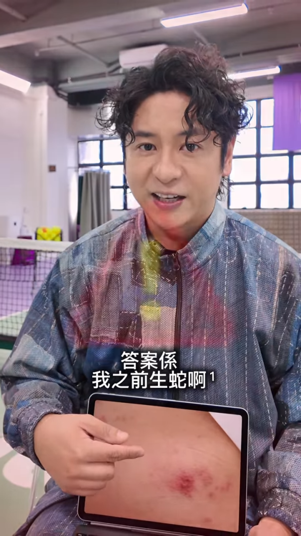 許廷鏗驚爆生蛇被迫停工抗病魔！術後失調左手大片瘀血痛到情緒崩潰