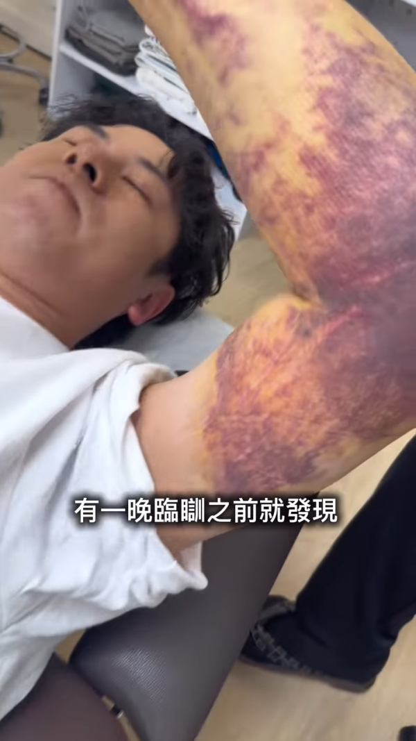 許廷鏗驚爆生蛇被迫停工抗病魔！術後失調左手大片瘀血痛到情緒崩潰