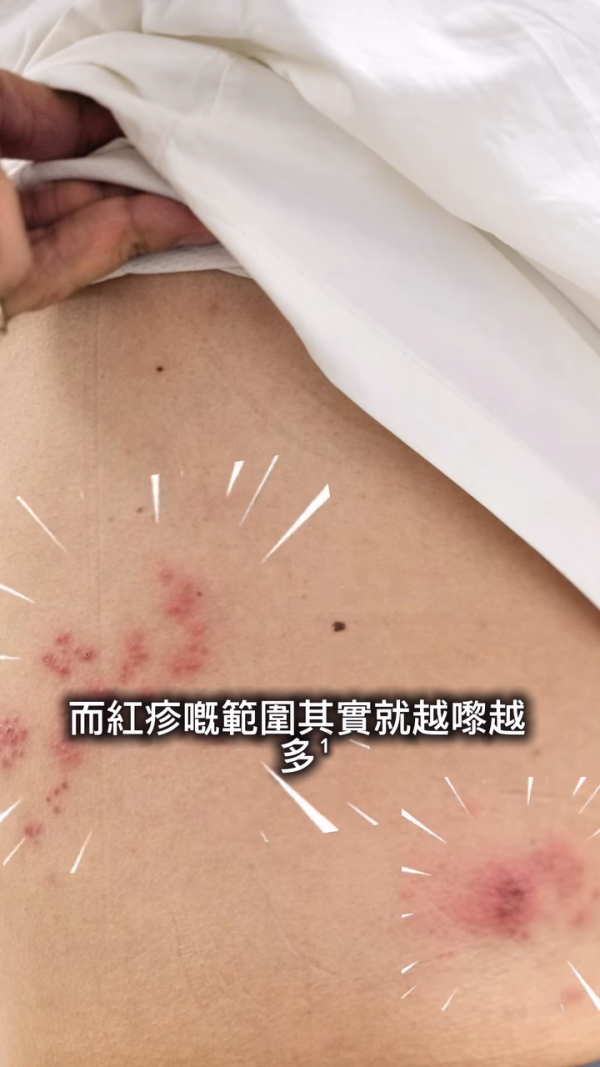 許廷鏗驚爆生蛇被迫停工抗病魔！術後失調左手大片瘀血痛到情緒崩潰