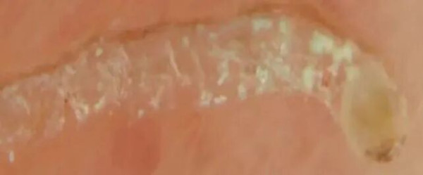深圳爆疥瘡傳染性極高一家5口中招！初期似濕疹恐致敗血症 酒店/按摩最高危？