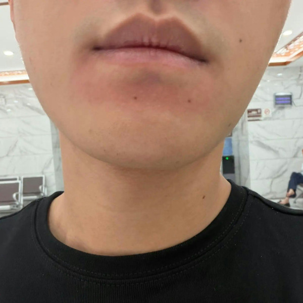 做gym用手抹汗致香港腳上臉！健身室器械真菌超標／中醫推介2大去濕抗菌湯水及外洗方