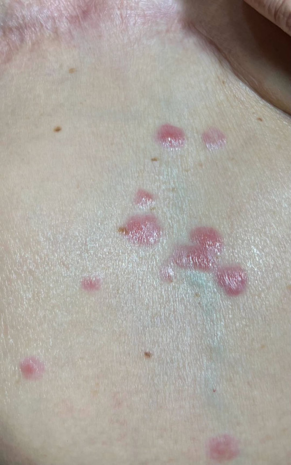 腹部生紅疹以為普通濕疹？70歲婦不痛不癢驚查竟是乳癌皮膚轉移／醫生警告5大症狀即就醫