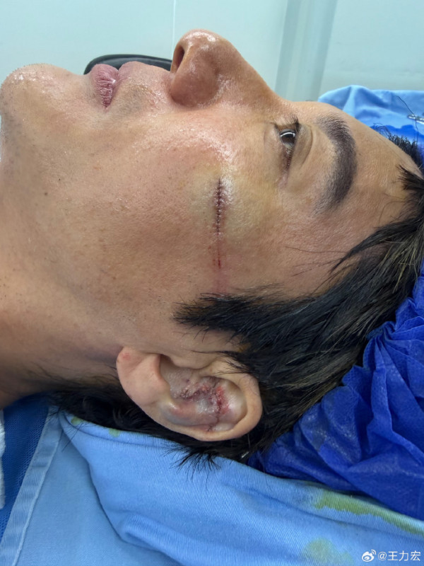 王力宏演唱會台上發生嚴重意外 流血送院共縫39針 受傷畫面觸目驚心