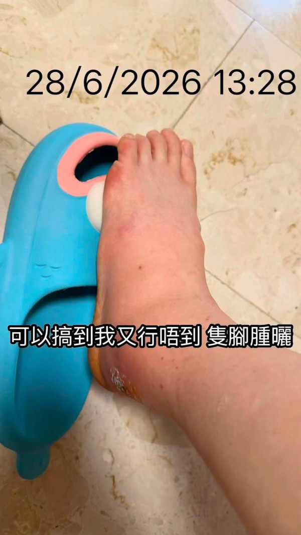 抓破蚊爛隨時喪命？港女染蜂窩組織炎行唔到 醫生揭2類人極高危促即求醫