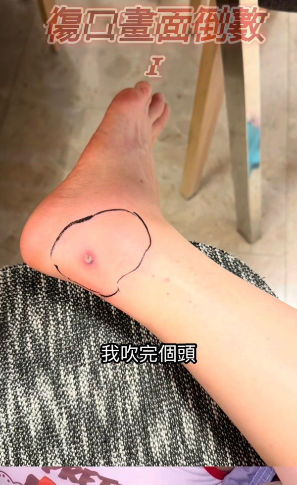 抓破蚊爛隨時喪命？港女染蜂窩組織炎行唔到 醫生揭2類人極高危促即求醫